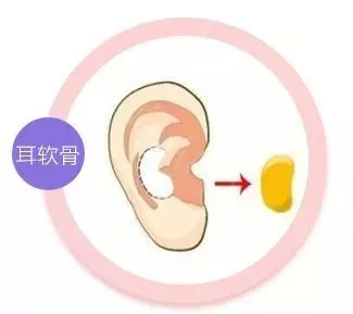 擔心鼻整形假體透光、發紅、移位?了解下自體軟骨