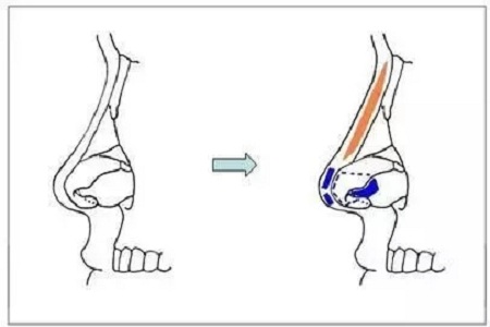 擔心鼻整形假體透光、發紅、移位?了解下自體軟骨