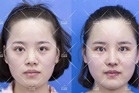 擔心鼻整形假體透光、發紅、移位?了解下自體軟骨