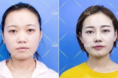 擔心鼻整形假體透光、發紅、移位?了解下自體軟骨