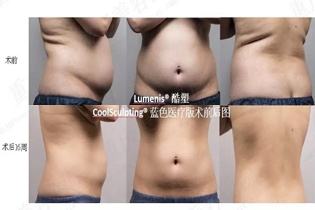 瘦身Flag挑戰賽 | “躺著就能瘦”真的不是夢，人人都可以！