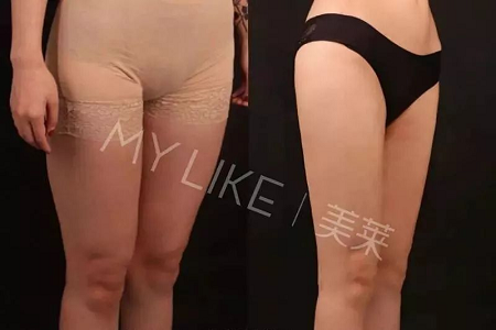 瘦身Flag挑戰賽 | “躺著就能瘦”真的不是夢，人人都可以！