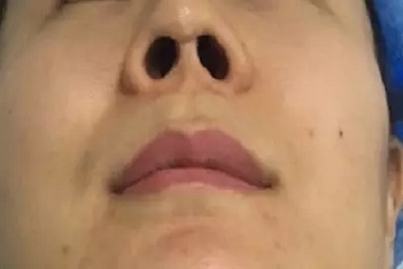 隆鼻手術(shù)切口在哪里?才能自然不留疤