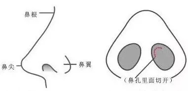 隆鼻手術(shù)切口在哪里?才能自然不留疤