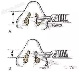 隆鼻手術(shù)切口在哪里?才能自然不留疤