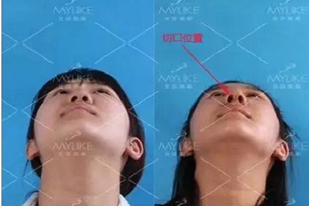 隆鼻手術(shù)切口在哪里?才能自然不留疤