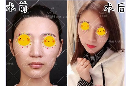 隆鼻手術(shù)切口在哪里?才能自然不留疤