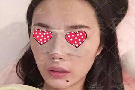 顏值：隆了個鼻子，男朋友說像換了一個女朋友