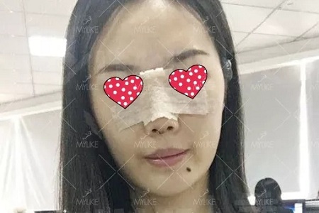 顏值：隆了個鼻子，男朋友說像換了一個女朋友