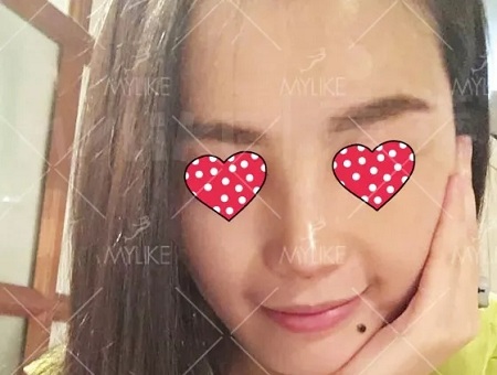 顏值：隆了個鼻子，男朋友說像換了一個女朋友