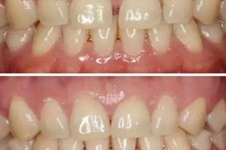 矯正 PK 牙貼面！關(guān)閉牙縫應(yīng)該pick哪一個(gè)？