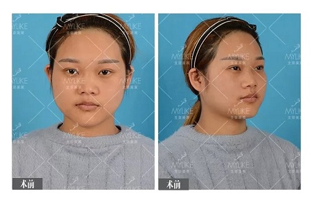 顏值:鼻子的改變能讓一個女孩變化有多大?