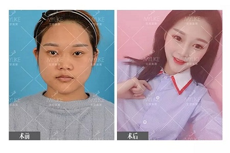 顏值:鼻子的改變能讓一個女孩變化有多大?