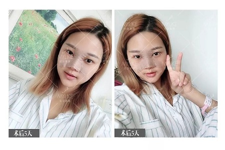 顏值:鼻子的改變能讓一個女孩變化有多大?