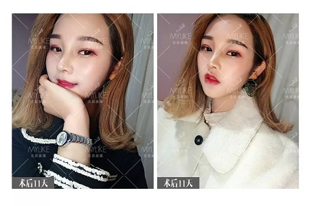 顏值:鼻子的改變能讓一個女孩變化有多大?