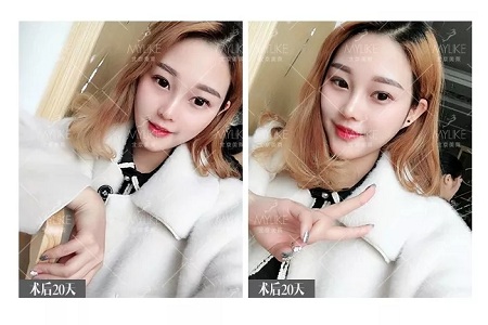 顏值:鼻子的改變能讓一個女孩變化有多大?