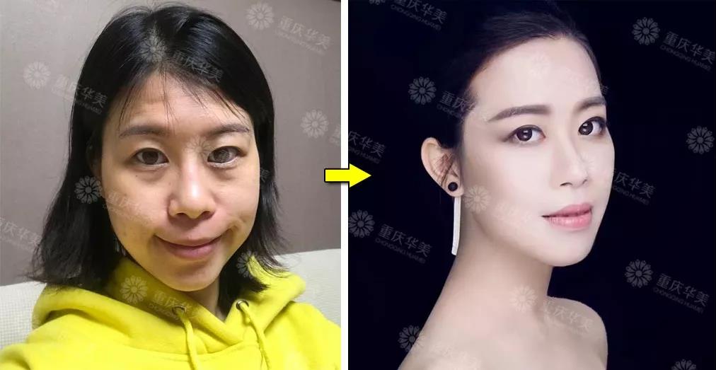 瘦臉針+玻尿酸填充，難看的法令紋、淚溝全消失！