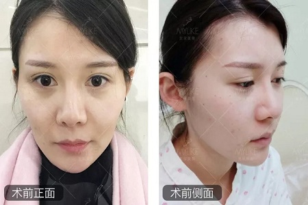 顏值:做完自體脂肪填充15天后,她變啥樣了?