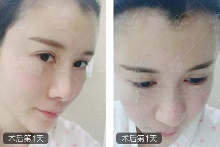 顏值:做完自體脂肪填充15天后,她變啥樣了?