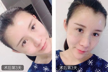 顏值:做完自體脂肪填充15天后,她變啥樣了?