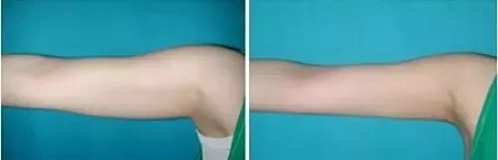 聽(tīng)說(shuō)很多不敢露胳膊的女生,胳膊上都有這個(gè)bug