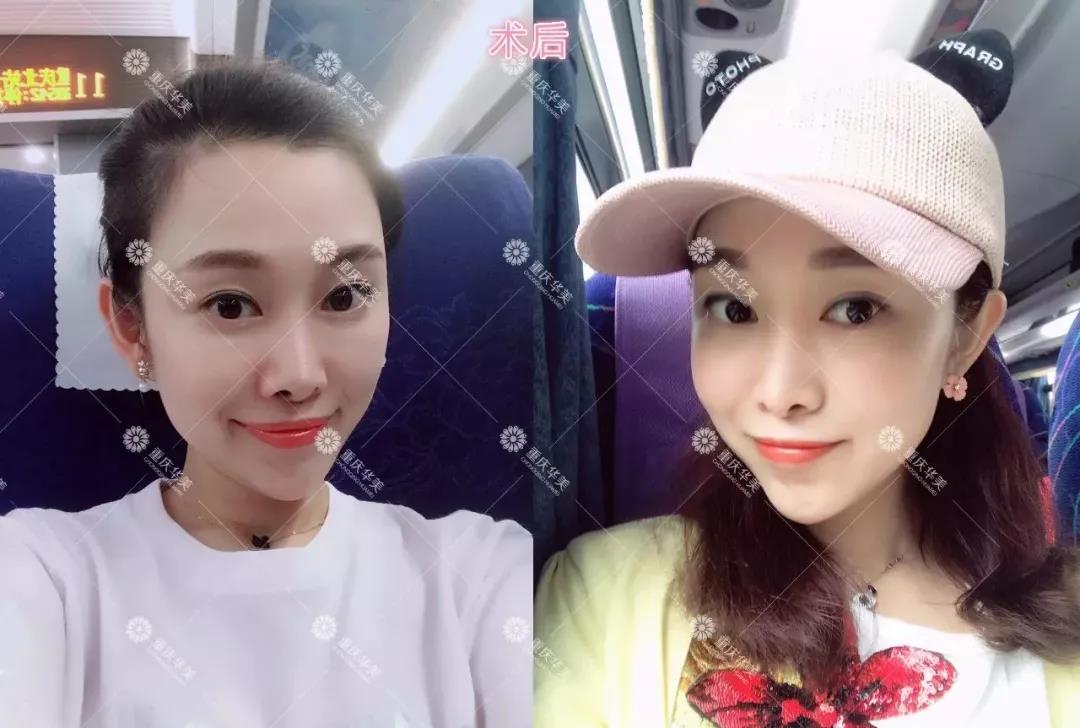 明星們都愛的玻尿酸，打了會上癮？真的假的