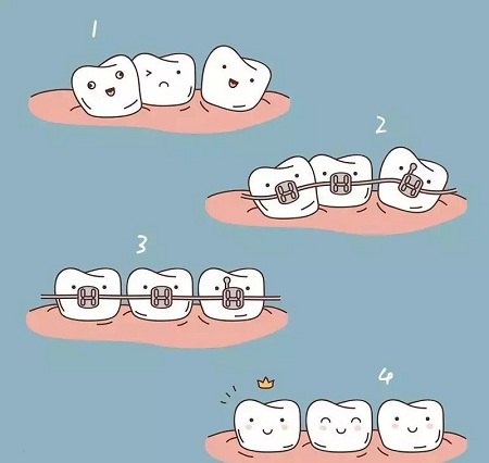 做牙齒矯正 ,真的要趁早!