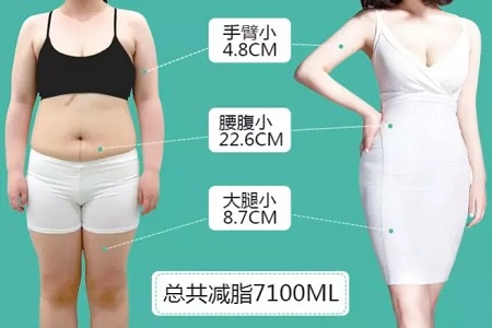 問診室:<a href='/xzjf/' target='_blank'><u>吸脂減肥</u></a>的四種誤區