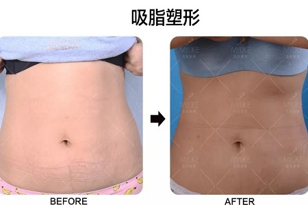 問診室:吸脂減肥的四種誤區