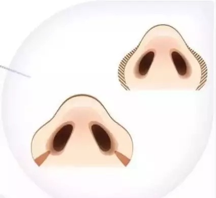 “鼻”需“整”救重磅開啟,你的鼻子即將C位出道了!