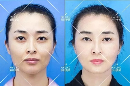 你討厭的脂肪,用在臉上就是寶貝!