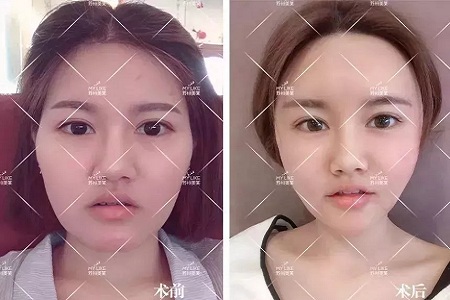 你討厭的脂肪,用在臉上就是寶貝!