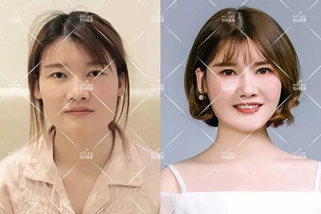 你討厭的脂肪,用在臉上就是寶貝!