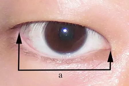 開眼角和不開眼角,差距有多大?