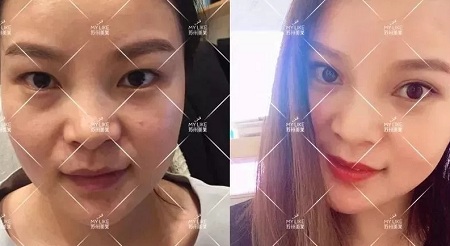 開眼角和不開眼角,差距有多大?