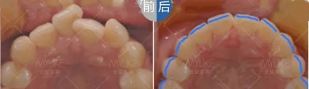 醫美白皮書:顏值爆表,全靠隱形牙套矯正!