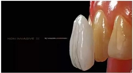 牙齒發黃怎么辦？還有救嗎？