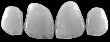 牙齒發黃怎么辦？還有救嗎？