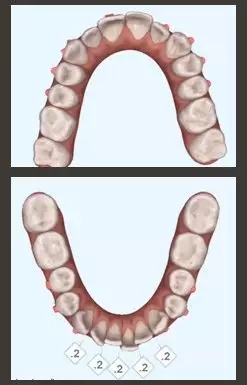 醫美白皮書:被透明牙套拯救的鋼牙妹們