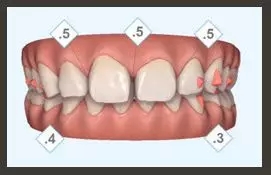 醫美白皮書:被透明牙套拯救的鋼牙妹們