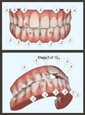 醫美白皮書:被透明牙套拯救的鋼牙妹們