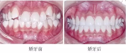 醫美白皮書:被透明牙套拯救的鋼牙妹們