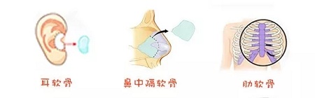 糾結(jié)！鼻頭太圓想塑形是用肋軟骨還是耳軟骨好？