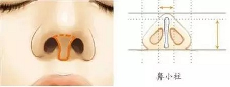 糾結(jié)！鼻頭太圓想塑形是用肋軟骨還是耳軟骨好？