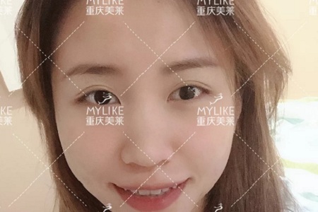 糾結(jié)！鼻頭太圓想塑形是用肋軟骨還是耳軟骨好？