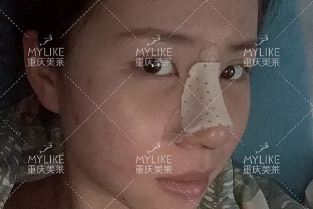 糾結(jié)！鼻頭太圓想塑形是用肋軟骨還是耳軟骨好？