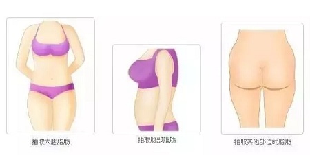 讓明星“一夜回春”的自體脂肪到底適不適合你?