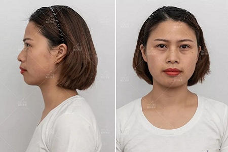 讓明星“一夜回春”的自體脂肪到底適不適合你?