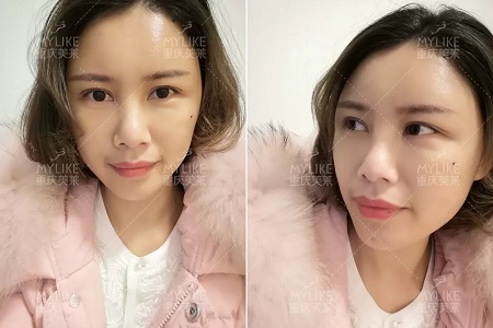 讓明星“一夜回春”的自體脂肪到底適不適合你?