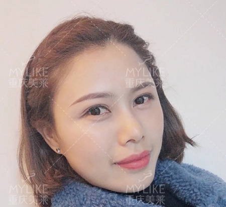 讓明星“一夜回春”的自體脂肪到底適不適合你?